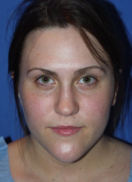 Picture8 Picture8 Rhinoplasty in Miami, FL