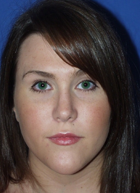 Picture9 Picture9 1 Rhinoplasty in Miami, FL