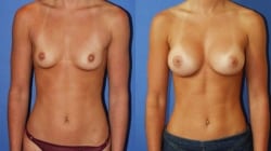 Picture9 Breast Augmentation