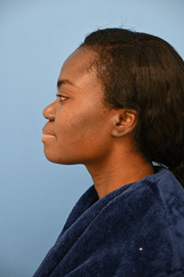 ethnic rhino 1a 1 Breast Reconstruction Miami - Breast Reconstruction Surgeon