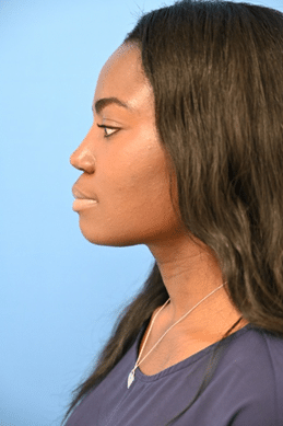 ethnic rhino 1b 1 Breast Reconstruction Miami - Breast Reconstruction Surgeon