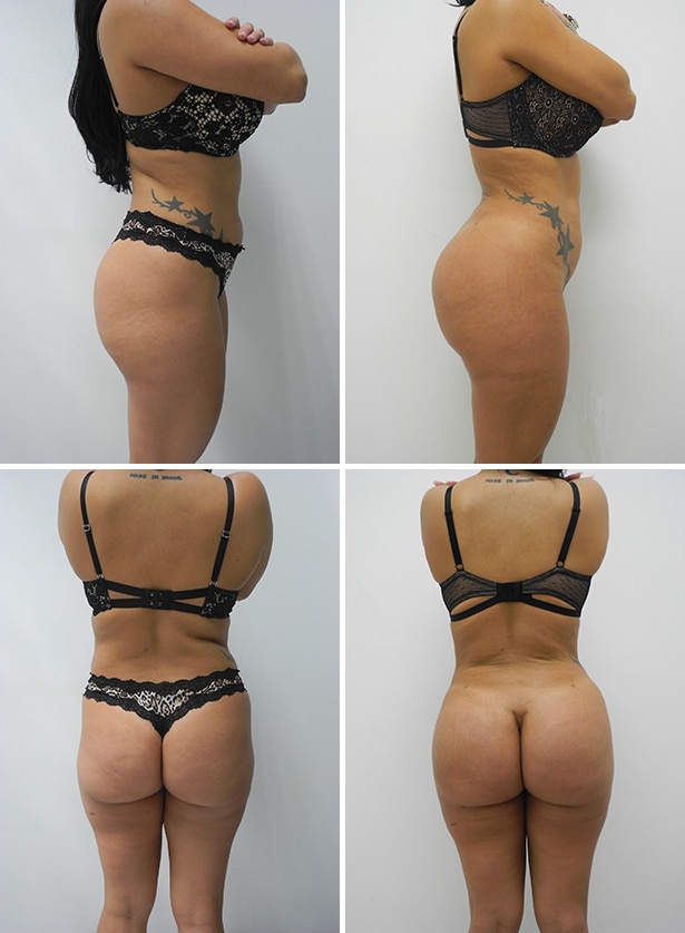 Before and After Image: Liposuction / Liposculpture Surgery - other