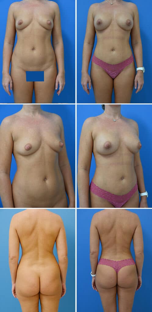 Before and After Image: Liposuction / Liposculpture Surgery - other