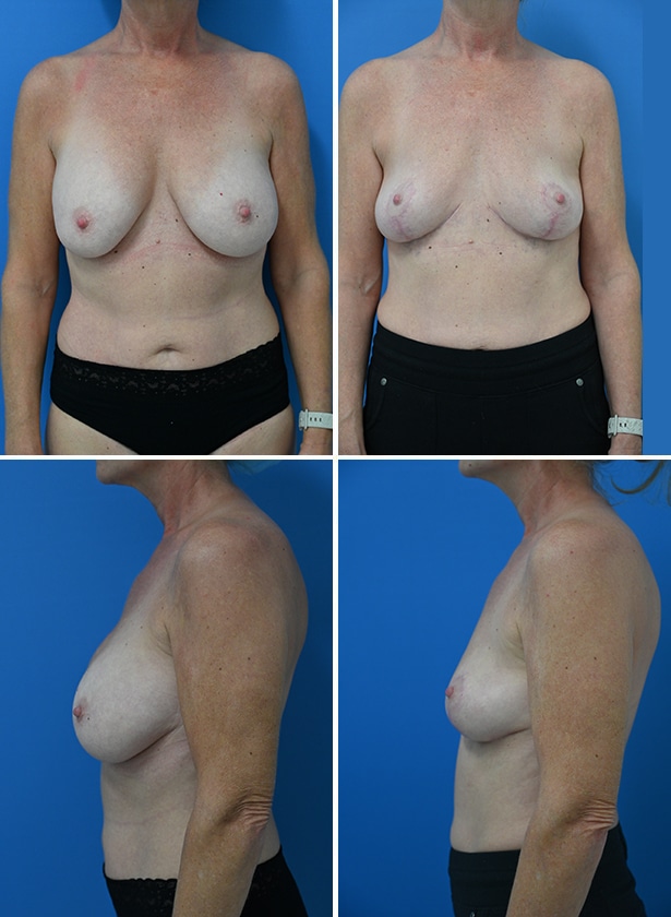 Before and After Image: Breast Lift - other
