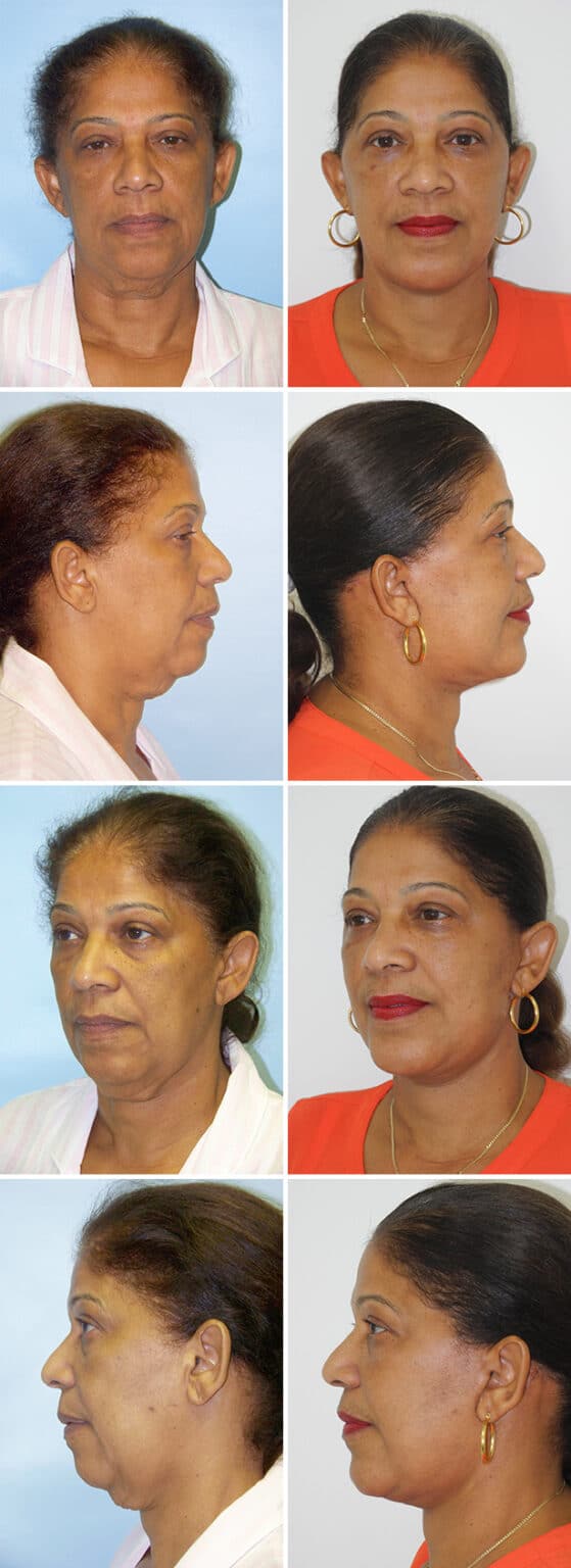 Before and After Image: Chin Augmentation Surgery - other