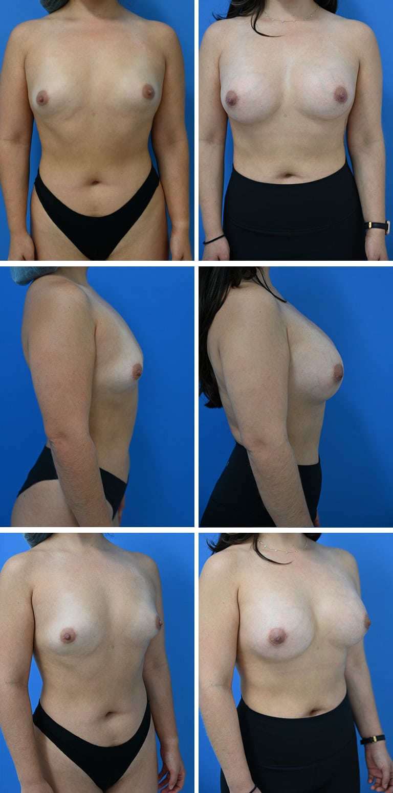 Before and After Image: Breast Augmentation - other