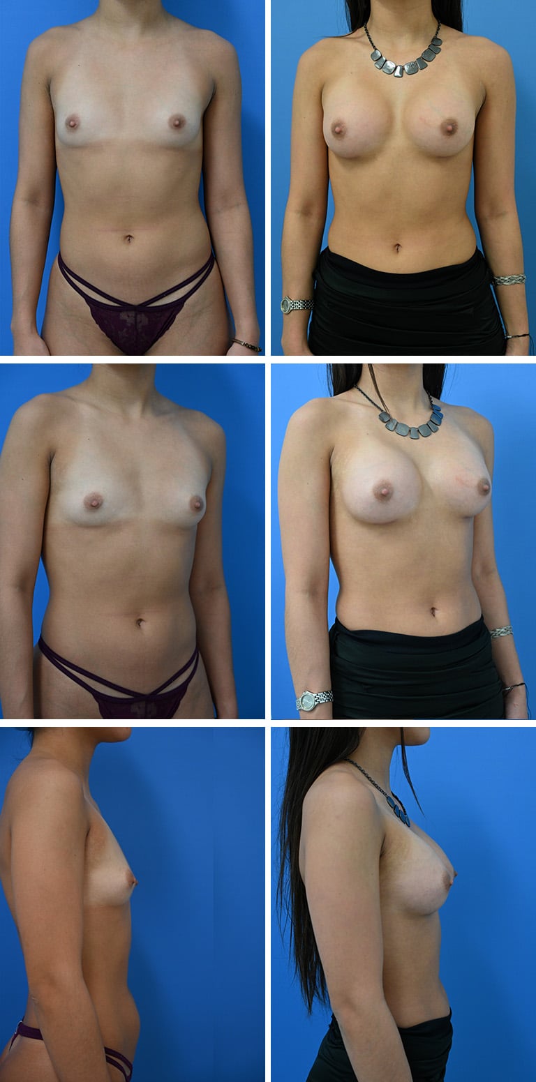 Before and After Image: Breast Augmentation - other
