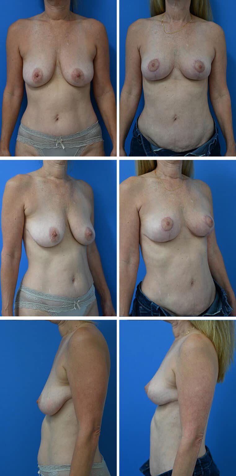 Before and After Image: Breast Lift - other