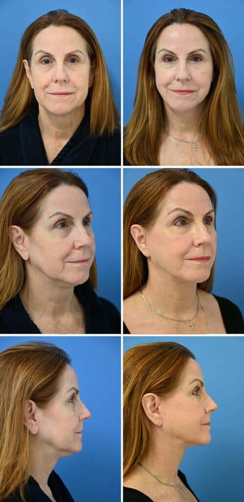 Before and After Image: Neck Lift Surgery - other