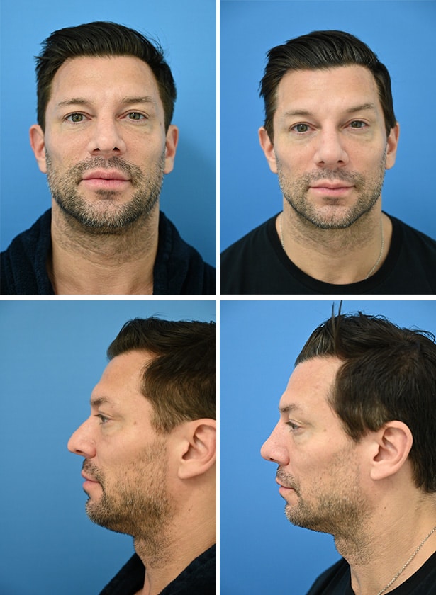 Before and After Image: Rhinoplasty - other