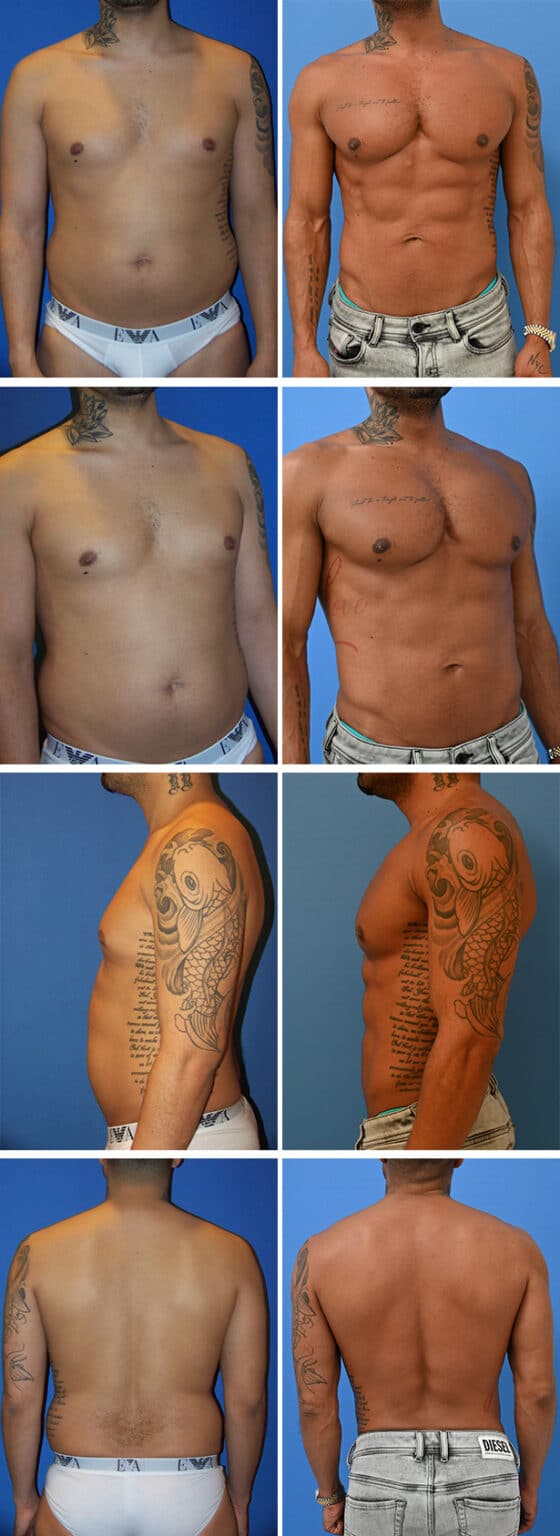 Before and After Image: Male Pectoral Implant - other