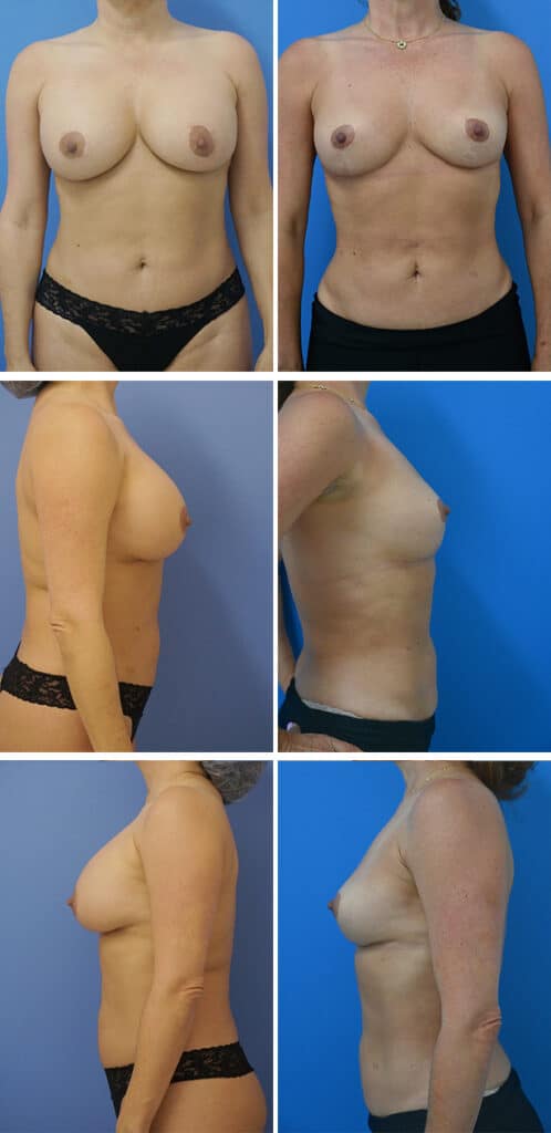 Before and After Image: Breast Lift (Mastopexy) - other