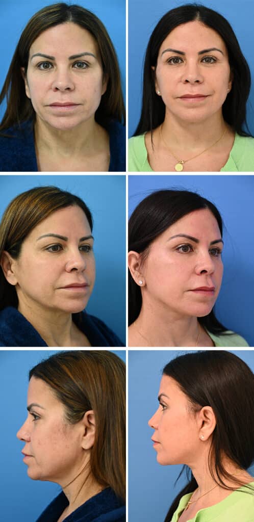 Before and After Image: Neck Lift Surgery - other