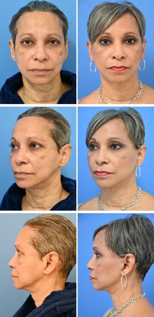 Before and After Image: Facelift Surgery - other