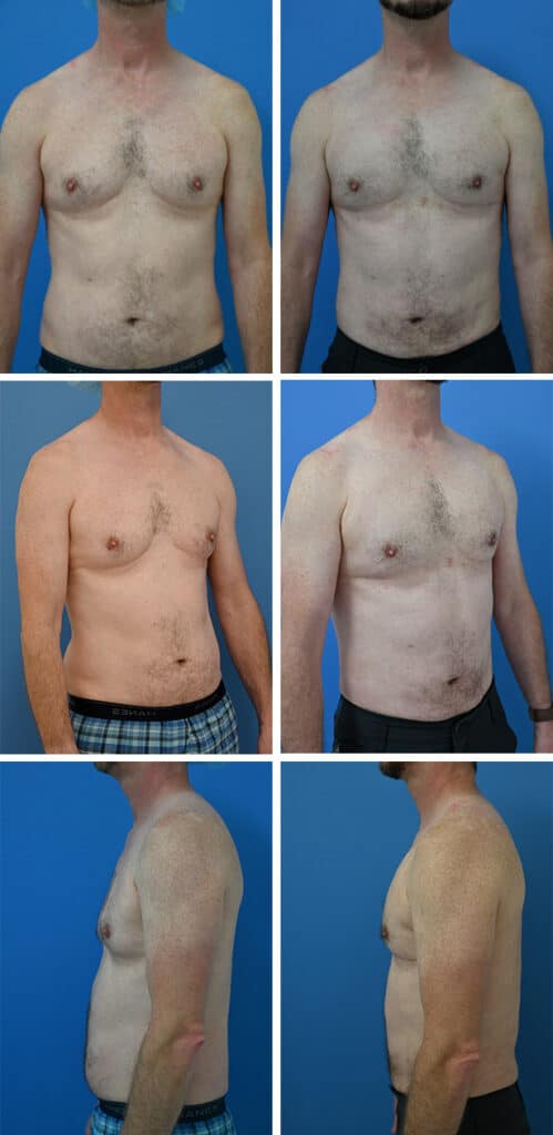 Before and After Image: Gynecomastia Correction - other