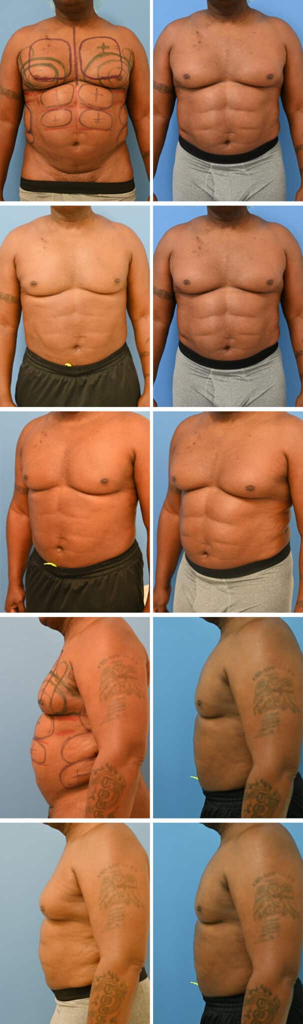 Before and After Image: Male Pectoral Implant - other