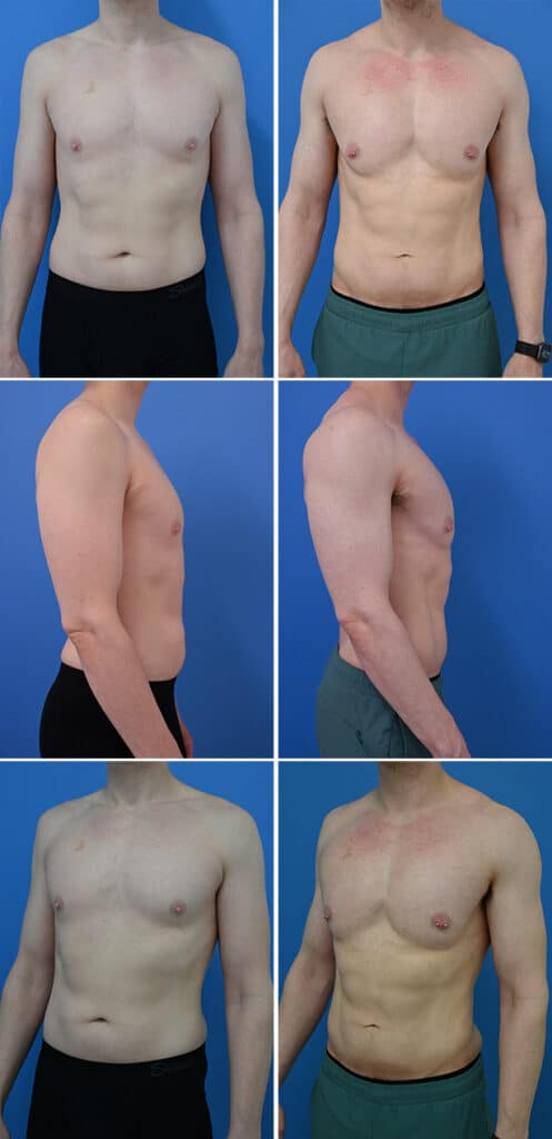 Before and After Image: Liposuction / Liposculpture Surgery - other