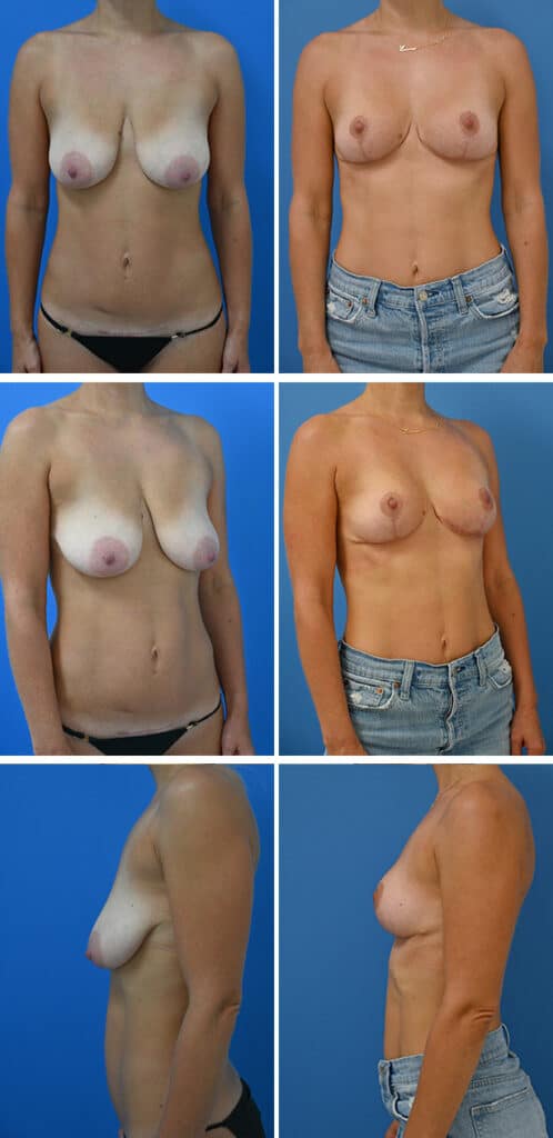 Before and After Image: Breast Lift (Mastopexy) - other