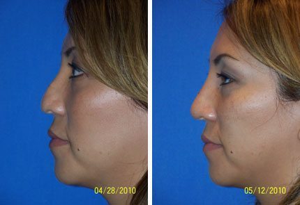 15minnosejob 15minnosejob Non-Surgical Rhinoplasty in Miami, FL