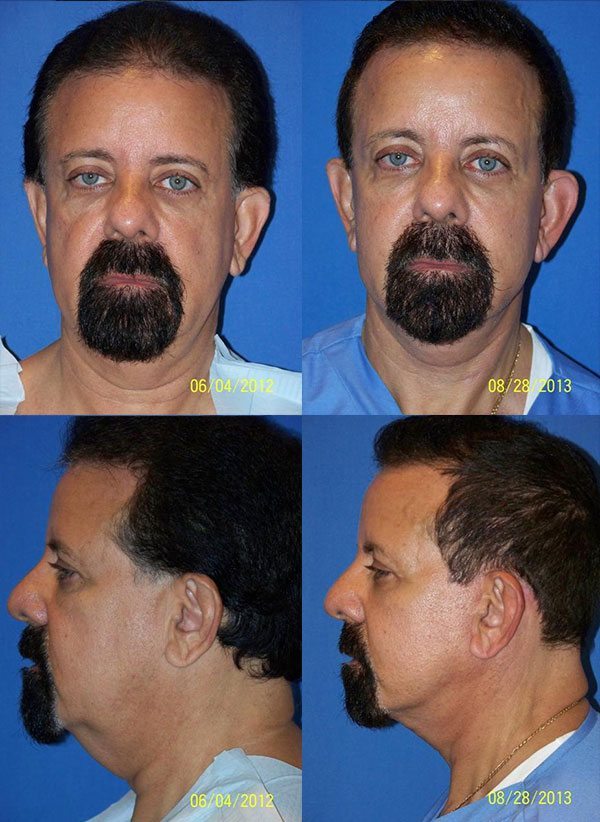 Before and After Image: Neck Lift Surgery - other