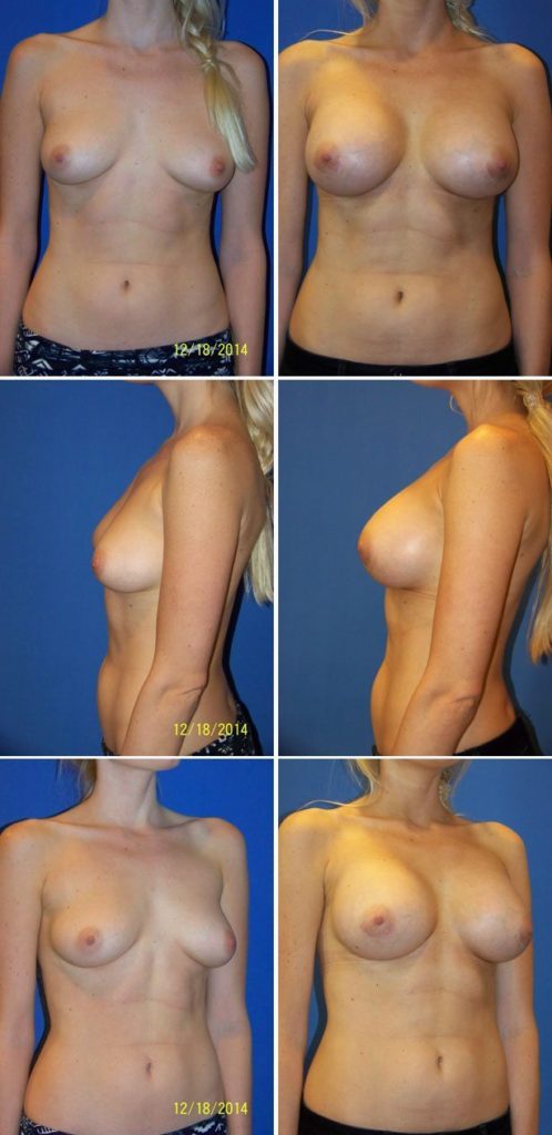 Before and After Image: Breast Augmentation - other
