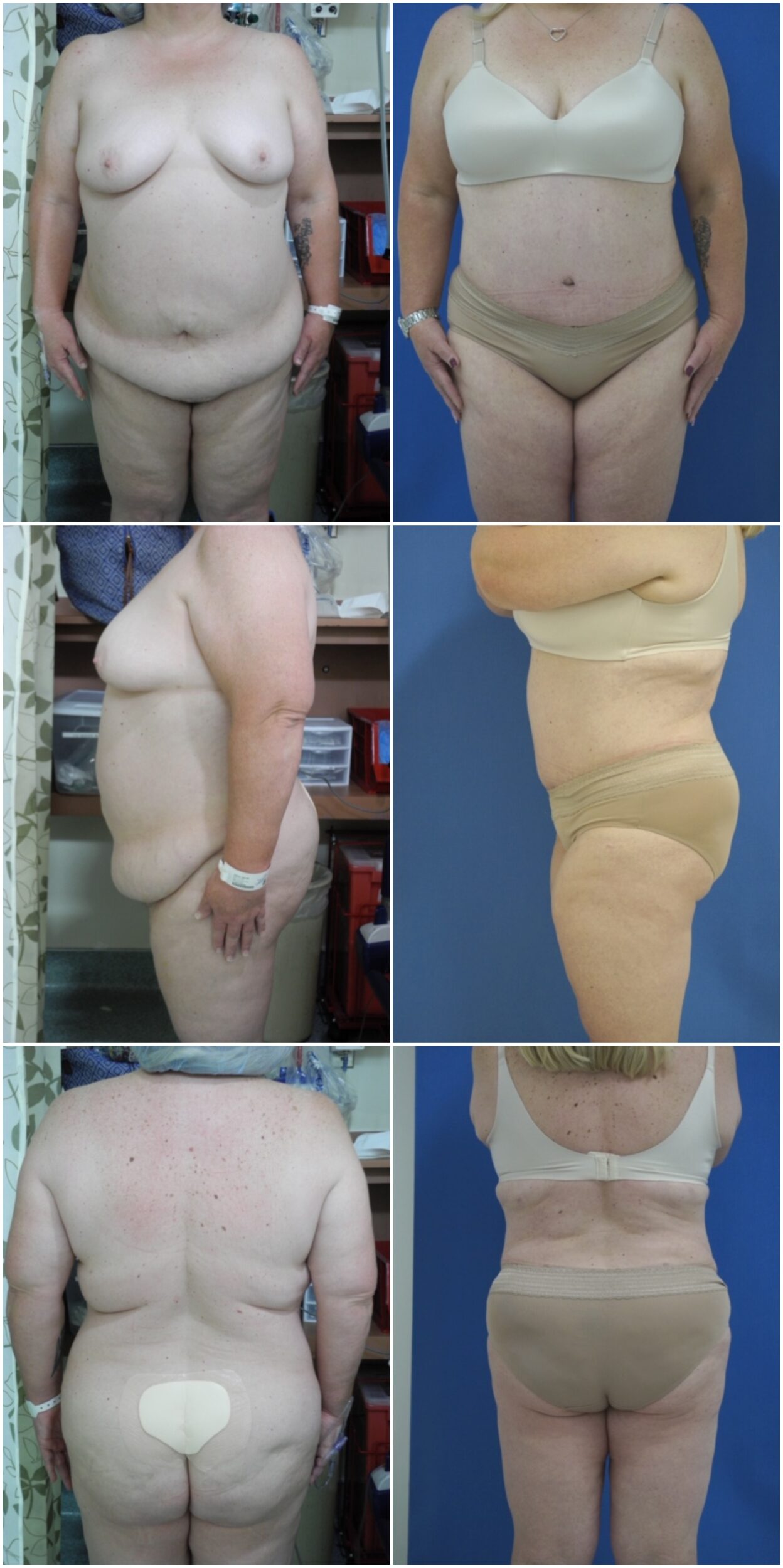 Before and After Image: Tummy Tuck (Abdominoplasty) - other