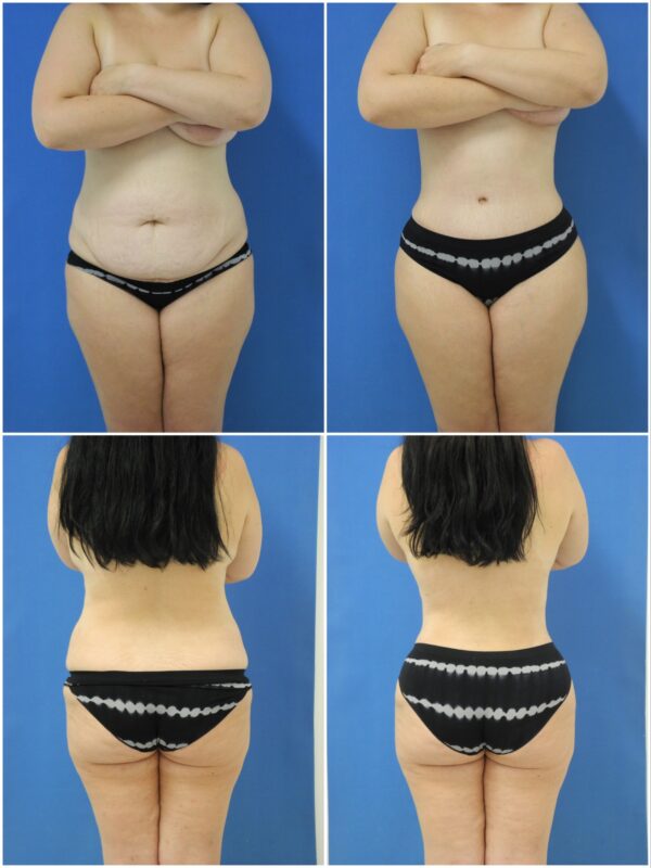 Before and After Image: Tummy Tuck (Abdominoplasty) - other