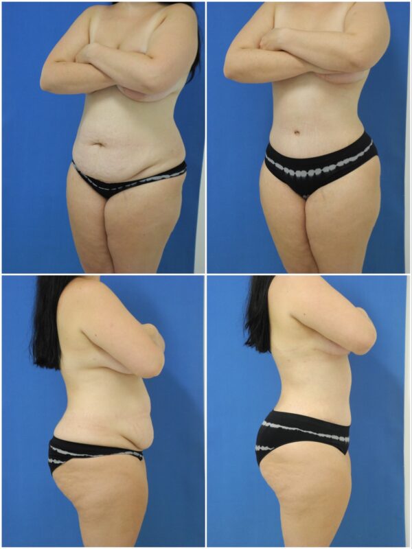 Before and After Image: Tummy Tuck (Abdominoplasty) - other