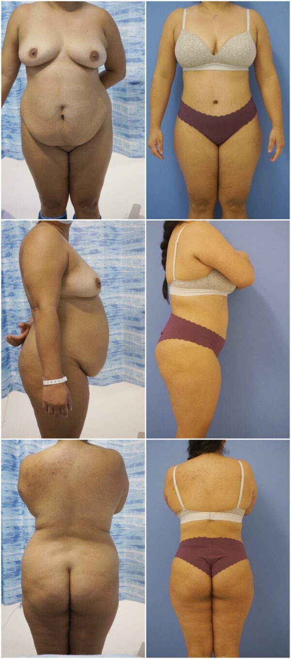 Before and After Image: Tummy Tuck (Abdominoplasty) - other
