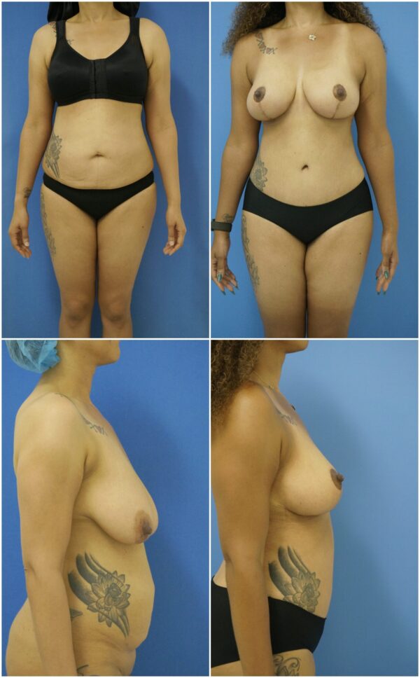 Before and After Image: Tummy Tuck (Abdominoplasty) - other