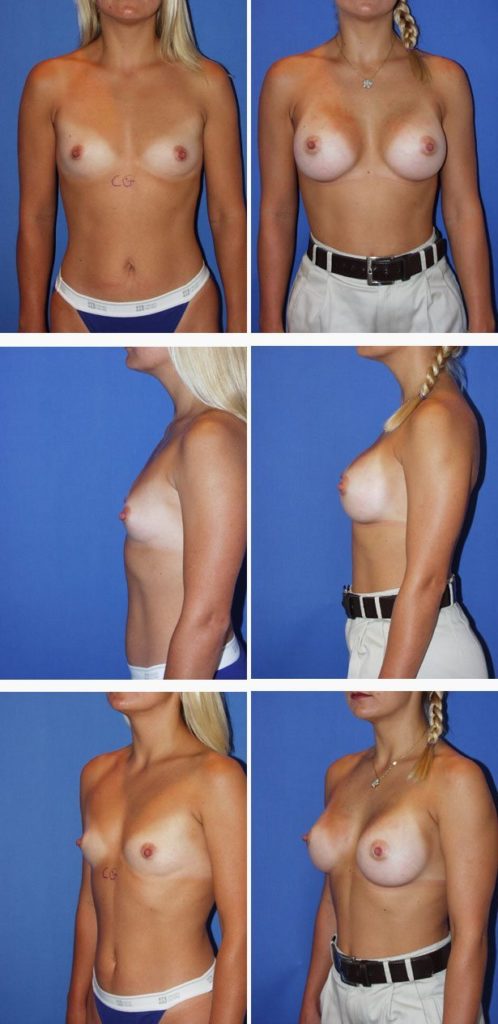 Before and After Image: Breast Augmentation - other