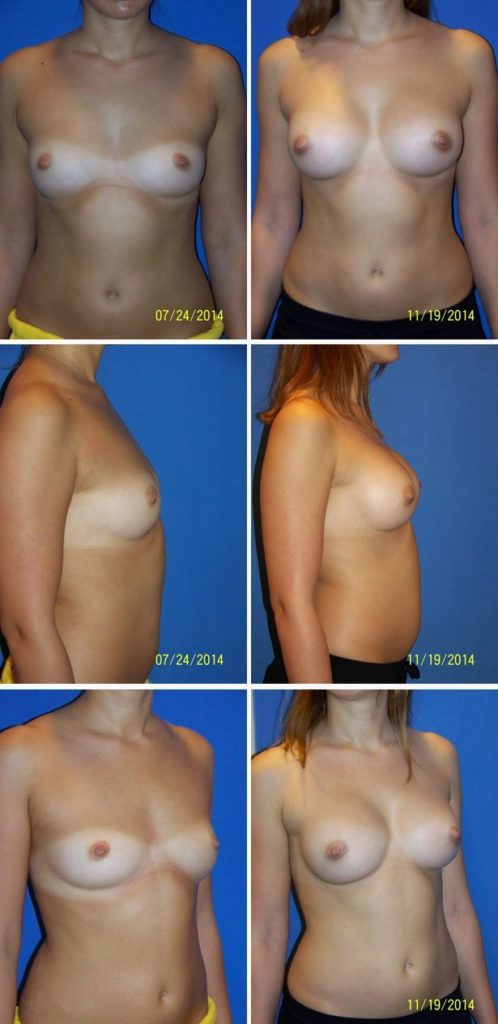 Before and After Image: Breast Augmentation - other