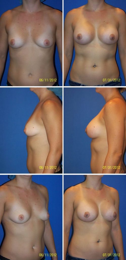 Before and After Image: Breast Augmentation - other