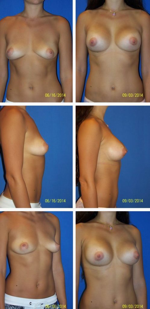 Before and After Image: Breast Augmentation - other