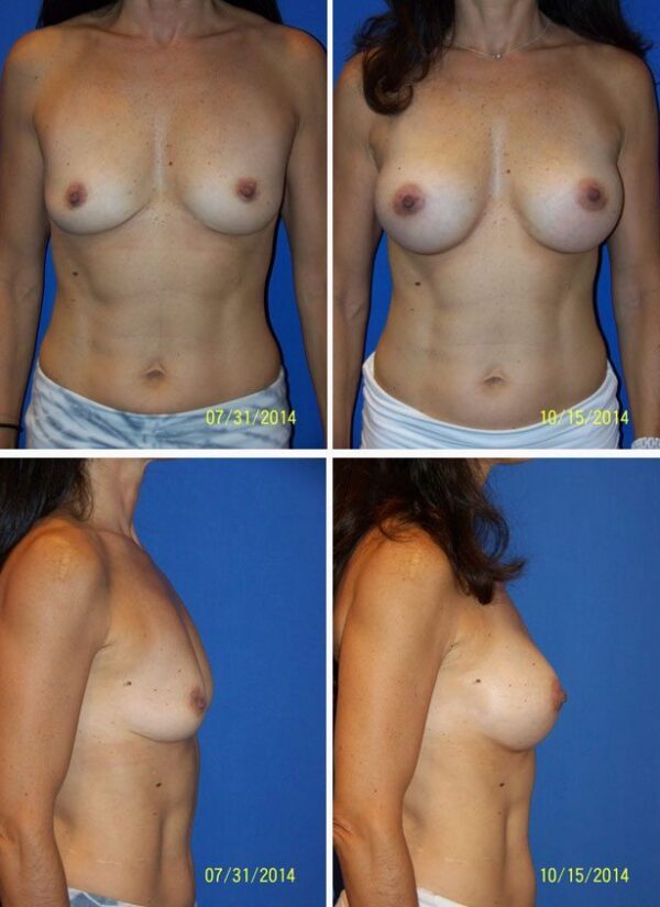 Before and After Image: Breast Augmentation - other