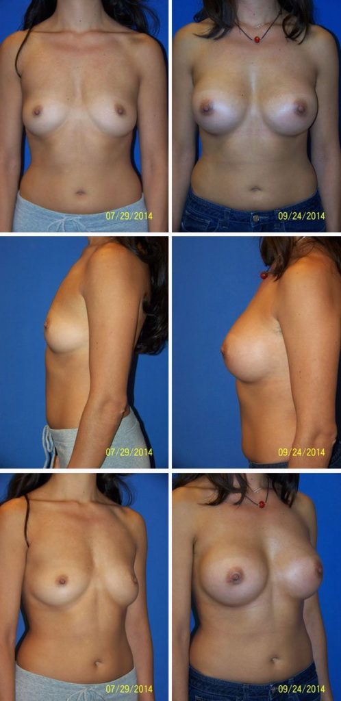 Before and After Image: Breast Augmentation - other