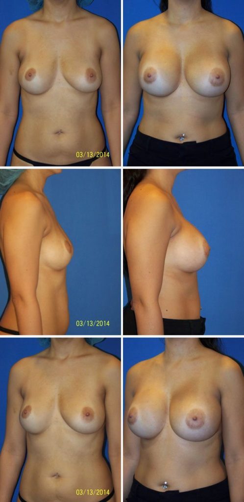 Before and After Image: Breast Augmentation - other