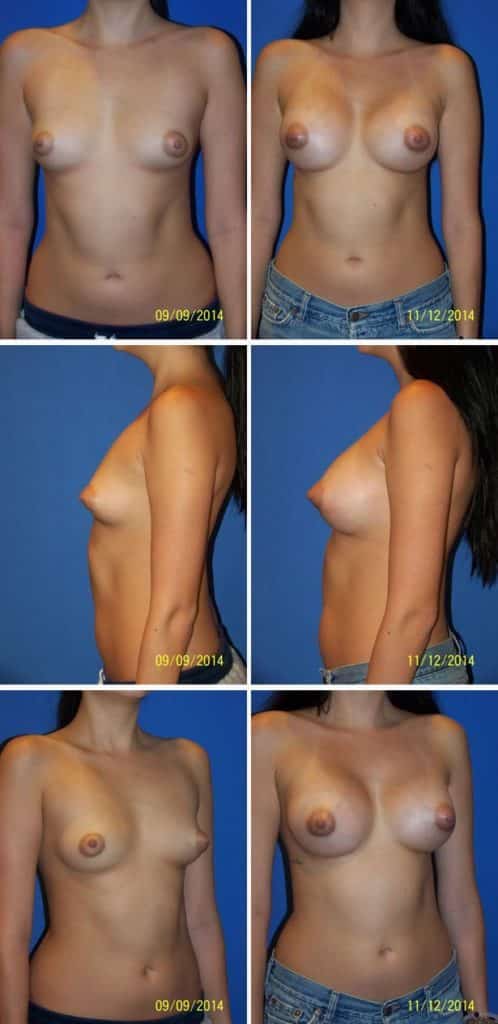 Before and After Image: Breast Augmentation - other