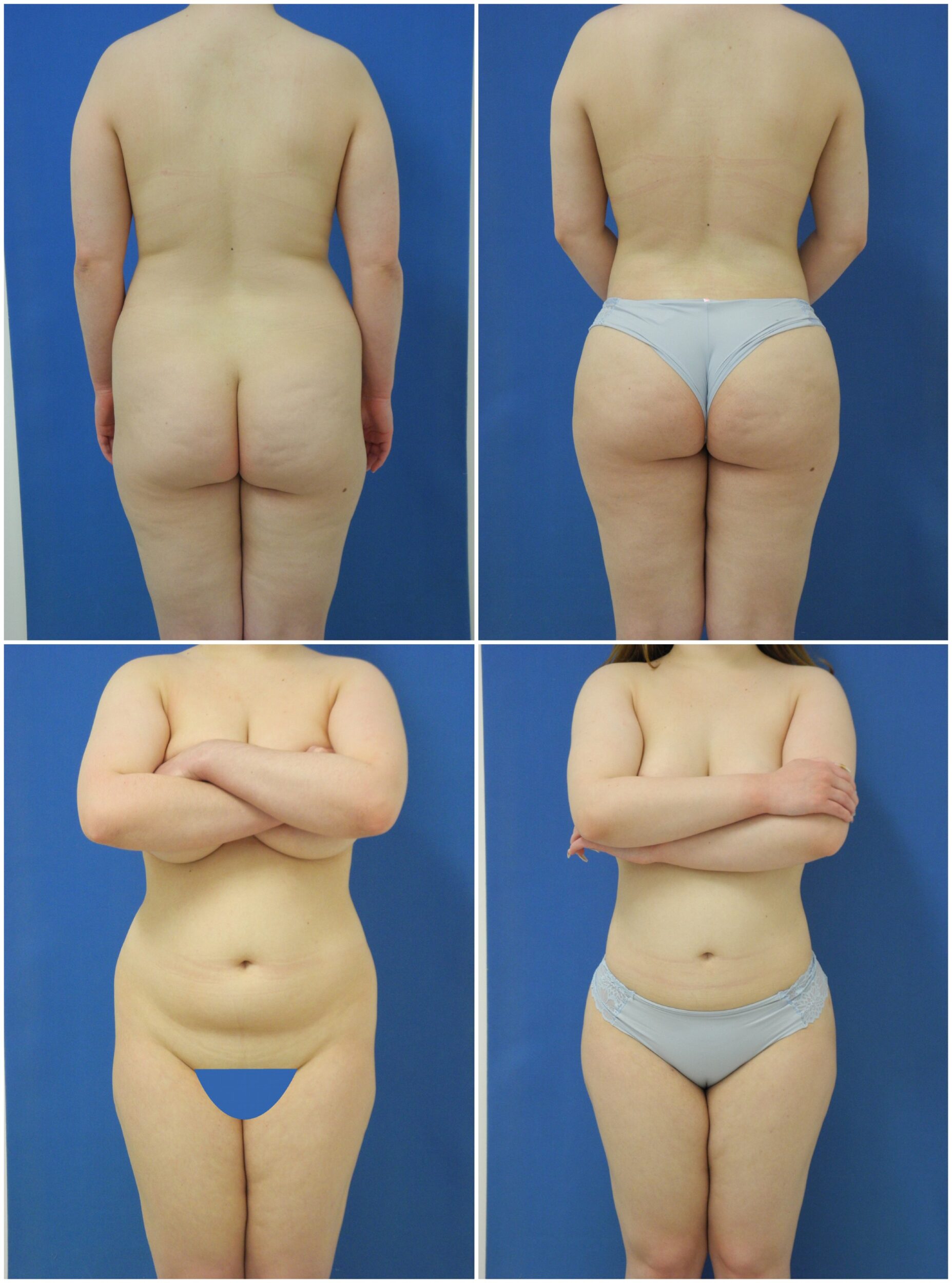 Before and After Image: Liposuction / Liposculpture Surgery - other