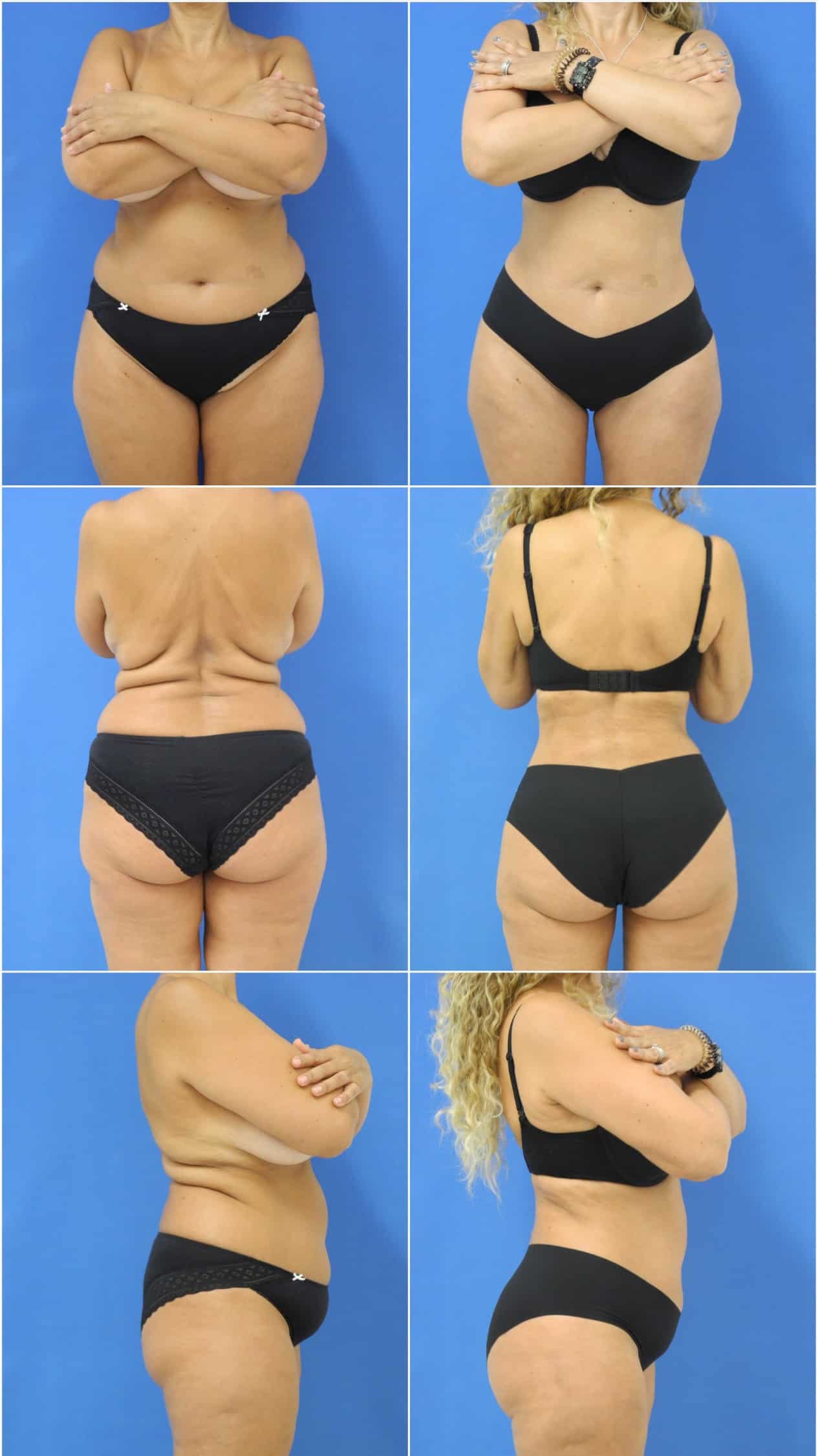 Before and After Image: Liposuction / Liposculpture Surgery - other