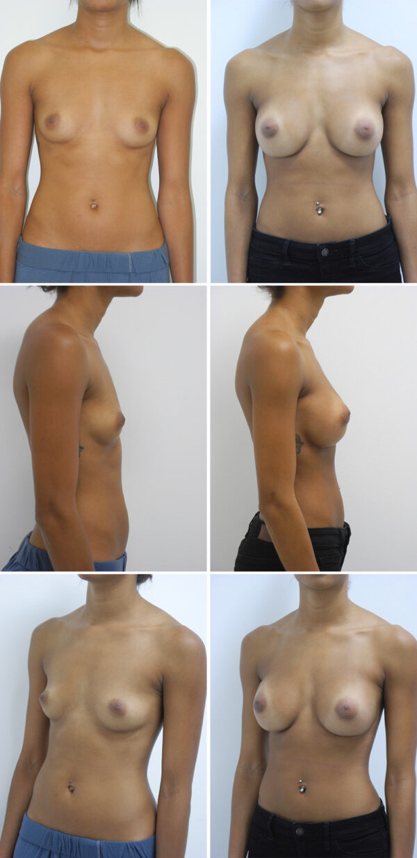 Before and After Image: Breast Augmentation - other