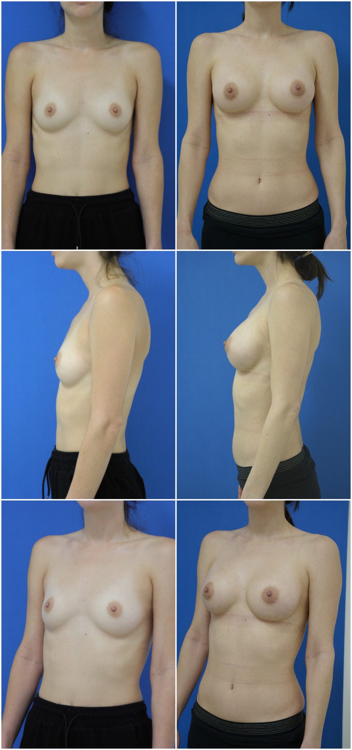 Before and After Image: Breast Augmentation - other