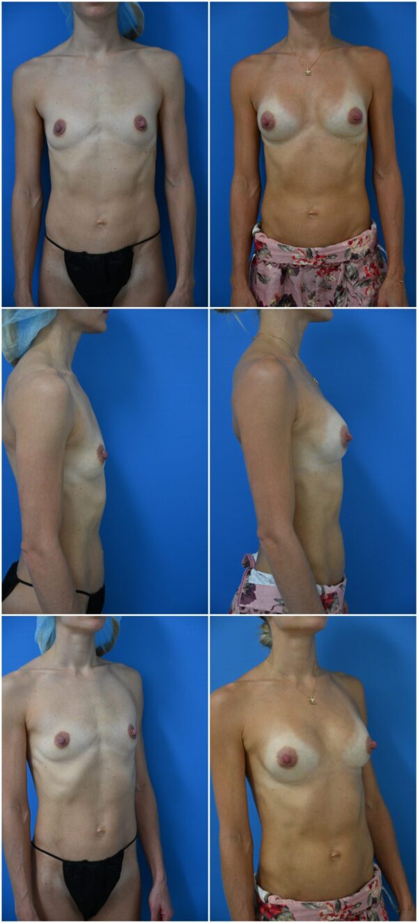 Before and After Image: Breast Augmentation - other