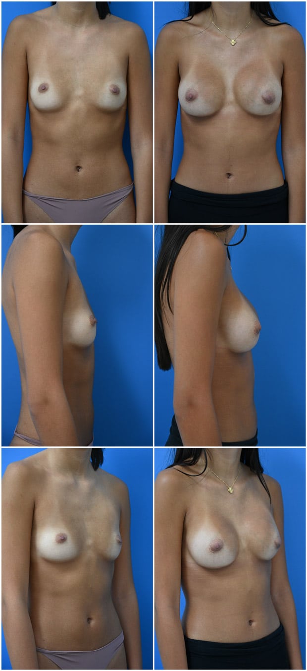 Before and After Image: Breast Augmentation - other