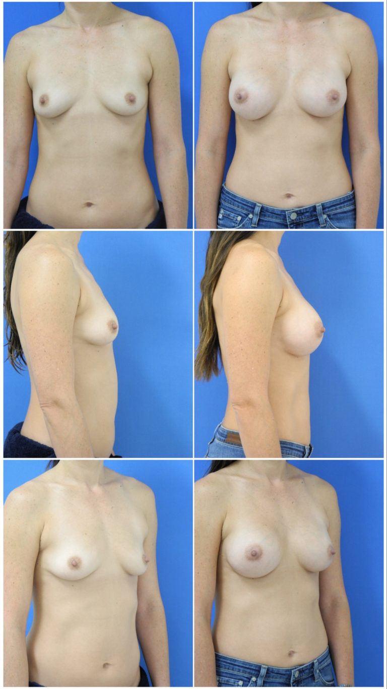Before and After Image: Breast Augmentation - front