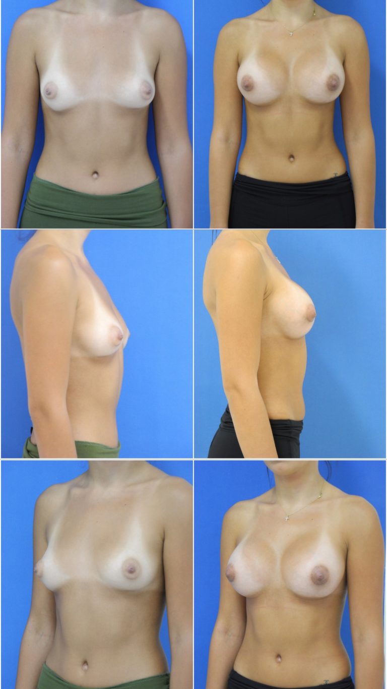 Before and After Image: Breast Augmentation - other