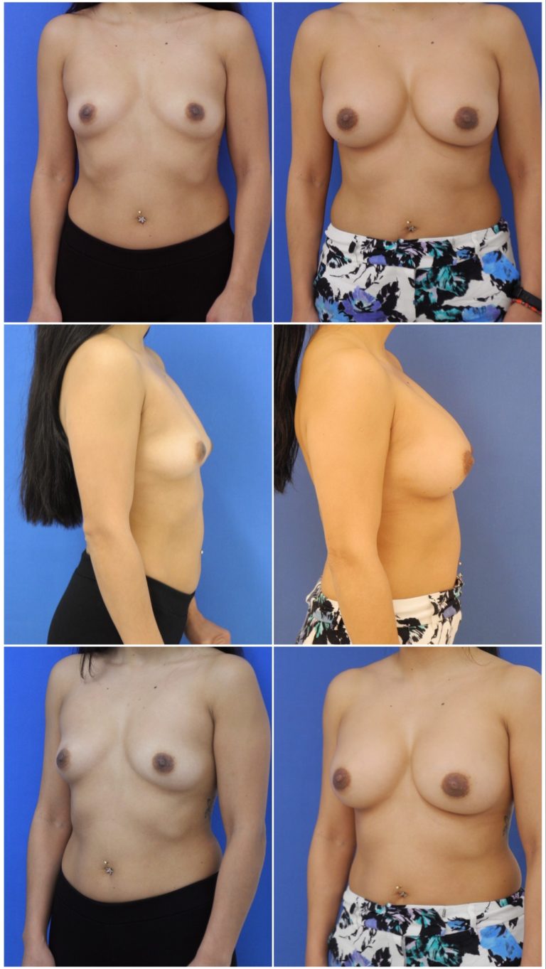 Before and After Image: Breast Augmentation - other