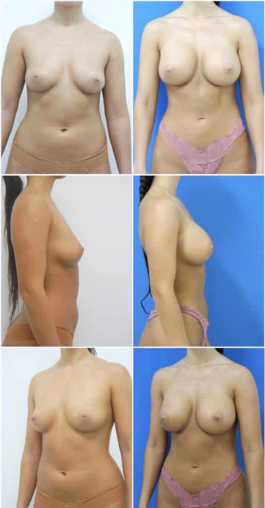 Before and After Image: Breast Augmentation - other