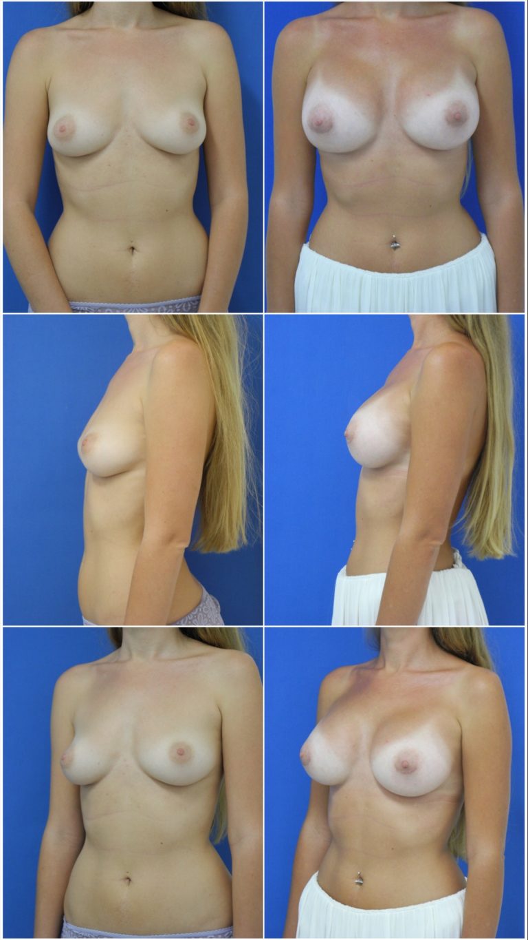 Before and After Image: Breast Augmentation - other