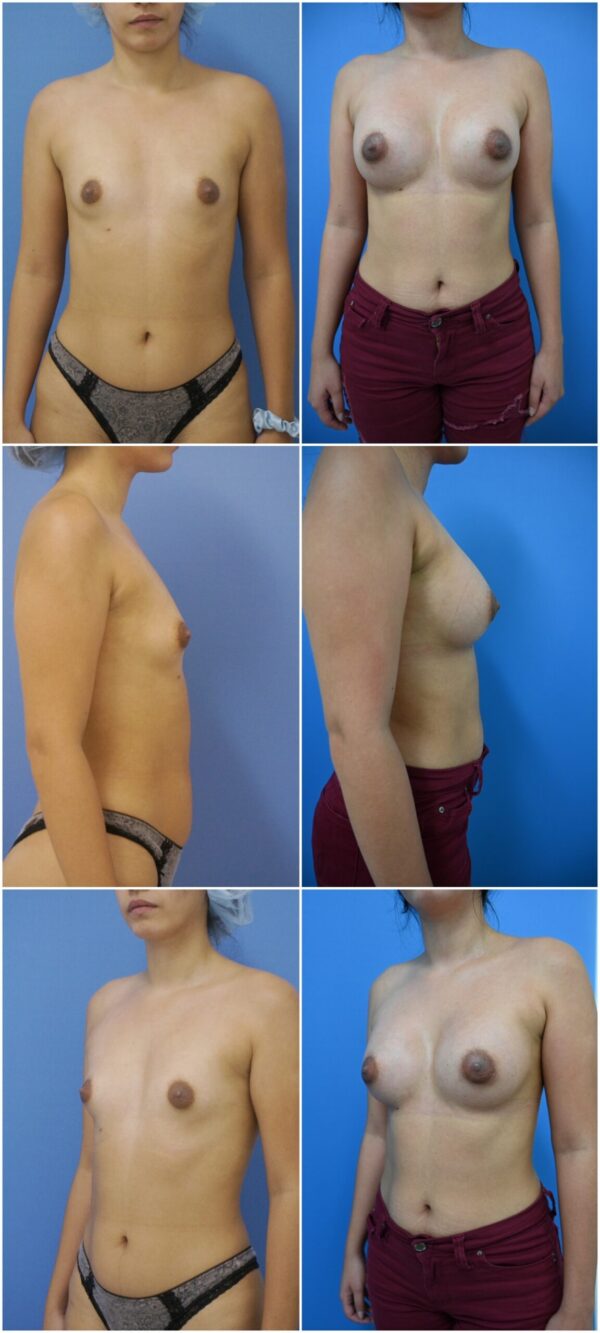 Before and After Image: Breast Augmentation - other